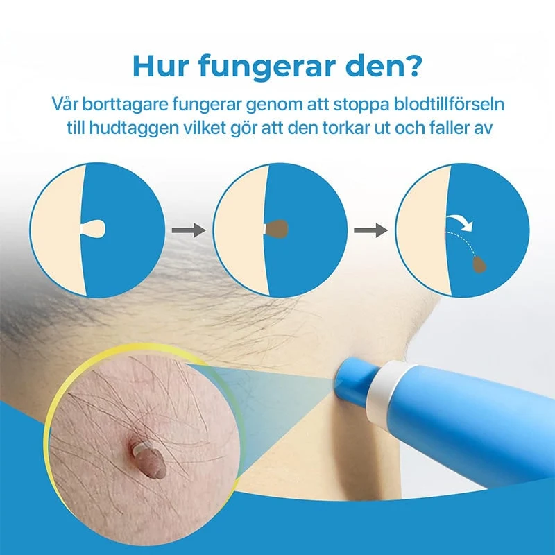 Skin Tag Removal Home Remover Kit with Band Applicator Tool for Armpit